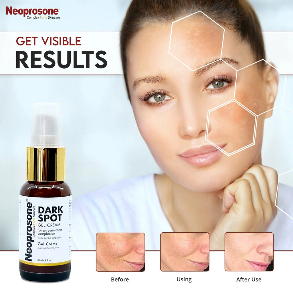 Neoprosone Dark Spot Remover Gel Crème – 30 ml / 1 fl oz